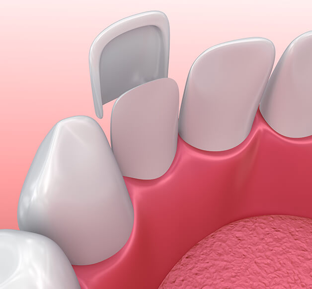 illustration of a dental veneer