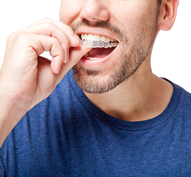 man inserting a clear aligner onto his teeth