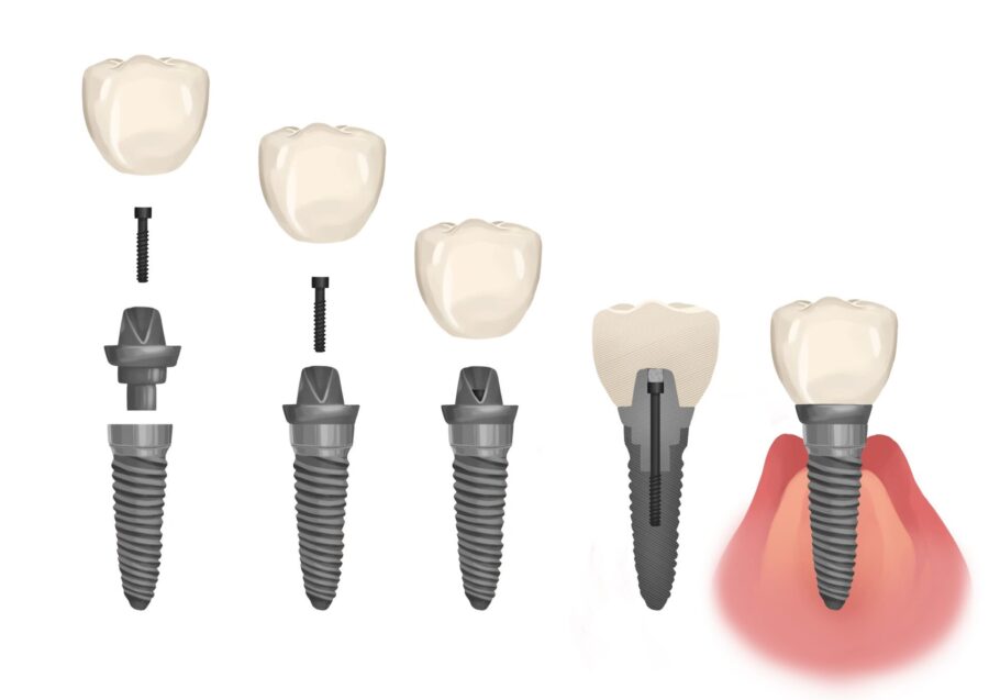 the parts of a dental implant including an implant restoration