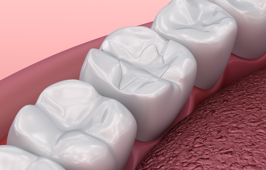 dental fillings, high filling, tooth colored filling