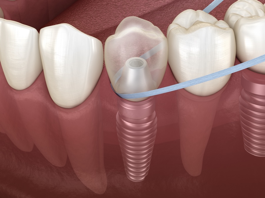 flossing around a dental implant, cleaning dental implant